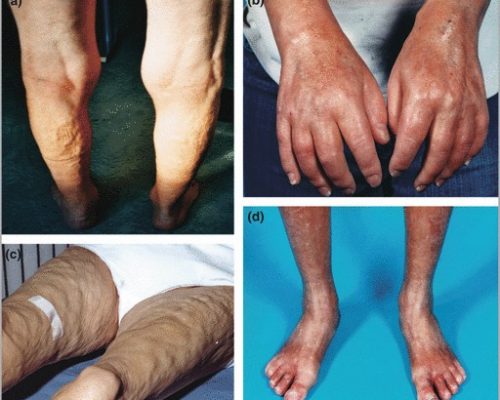 nephrogenic-systemic-fibrosis